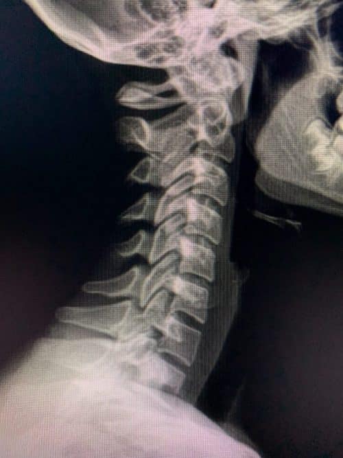 x-rays are a tool chiropractors use to improve patient care.