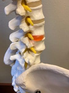 Sciatica often can be helped by chiropractic care. A disc herniation is one cause of sciatica.